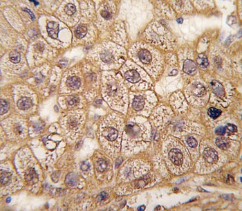 IHC staining of FFPE human hepatocarcinoma tissue with B2AR antibody. HIER: steam section in pH6 cit