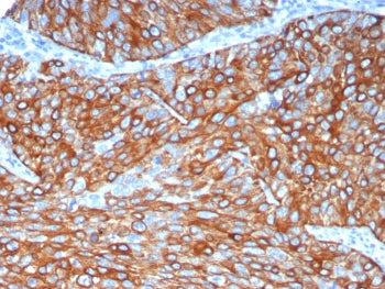 IHC staining of FFPE human lung adenocarcinoma tissue with Cytokeratin 6A antibody (clone KRT6/8120R