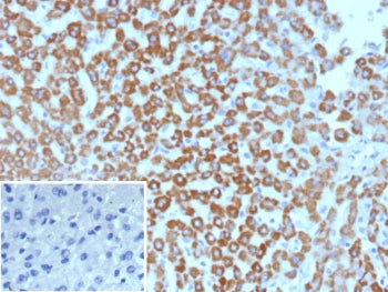 IHC staining of FFPE human hepatocellular carcinoma tissue with CPSase I antibody (clone CPS1/9869).