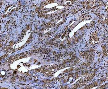 IHC staining of FFPE human colorectal adenocarcinoma tissue with NR5A2 antibody. HIER: boil tissue s