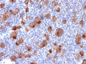 IHC testing of FFPE human Hodgkin's lymphoma stained with recombinant CD30 antibody (clone Ki-1/1747