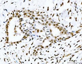 IHC staining of FFPE human breast cancer tissue with p53 binding protein 1 antibody. HIER: boil tiss