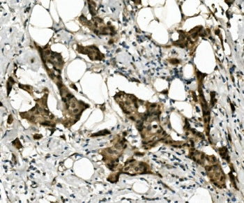 IHC staining of FFPE human breast cancer with RBPMS antibody. HIER: boil tissue sections in pH8 EDTA
