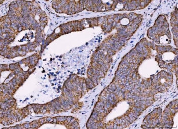 IHC staining of FFPE human colorectal adenocarcinoma tissue with MRPS18B antibody. HIER: boil tissue