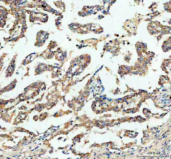 IHC staining of FFPE human lung cancer tissue with Bax antibody, HRP-labeled secondary and DAB subst