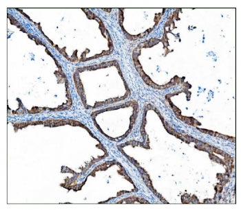 IHC staining of FFPE human ovarian cancer tissue with TBC1D4 antibody. HIER: boil tissue sections in