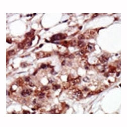 IHC analysis of FFPE human breast carcinoma tissue stained with the BRD4 antibody