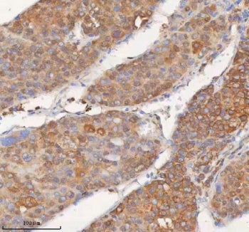 IHC staining of FFPE human liver cancer tissue with SHKBP1 antibody. HIER: boil tissue sections in p