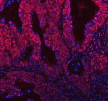 Immunofluorescent staining of FFPE human intestinal cancer tissue with SNRNP200 antibody (red) and D