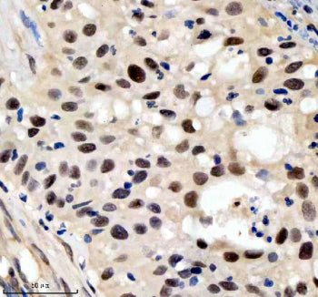 Immunohistochemical staining of SIN3B using anti-SIN3B antibody. SIN3B was detected in a paraffin-em
