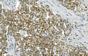 IHC staining of FFPE human renal carcinoma with IDH2 antibody. HIER: boil tissue sections in pH8 EDT