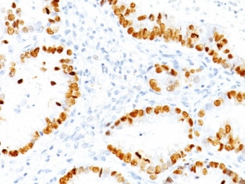 IHC: Formalin-fixed, paraffin-embedded human lung Adenocarcinoma stained with TTF-1 antibody (NX2.1/