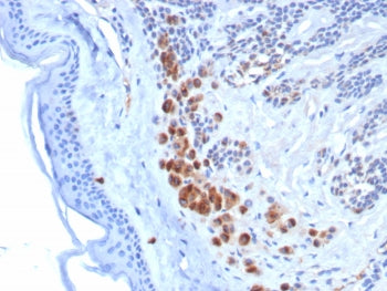 IHC staining of FFPE human melanoma tissue with Tyrosinase-Related Protein-1 antibody (clone TYRP1/8