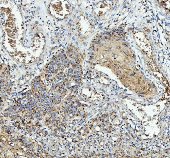 IHC staining of FFPE human esophageal squamous carcinoma tissue with IL1RA antibody. HIER: boil tiss