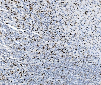 IHC staining of FFPE human lymphoma tissue with SAMHD1 antibody. HIER: boil tissue sections in pH8 E