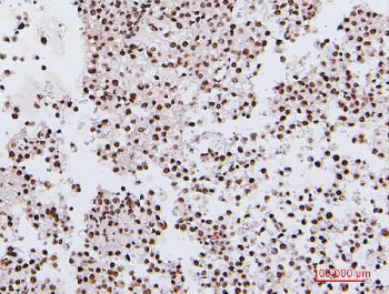 IHC staining of FFPE human testis cancer with NRF1 antibody. HIER: boil tissue sections in pH6, 10mM