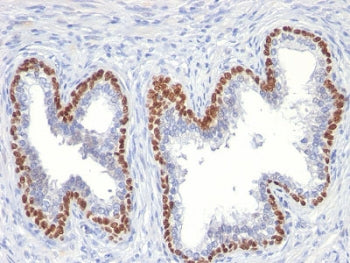 IHC testing of FFPE human prostate cancer with p63 antibody (clone TP63/11). HIER: boil tissue secti