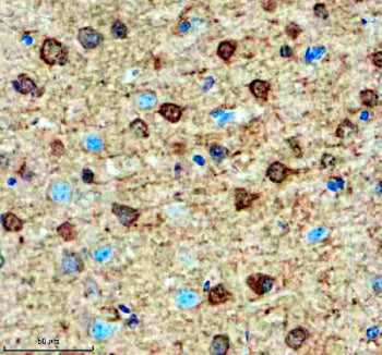 Immunohistochemical staining of SMARCAL1 using anti-SMARCAL1 antibody. SMARCAL1 was detected in a pa