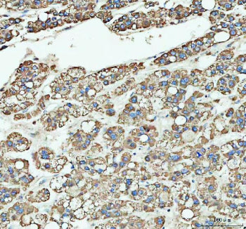 IHC staining of FFPE human liver cancer tissue with ARHGEF12 antibody, HRP-labeled secondary and DAB