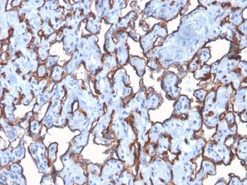 IHC staining of FFPE human angiocarcinoma with recombinant CD31 antibody (clone C31/2876R). Required