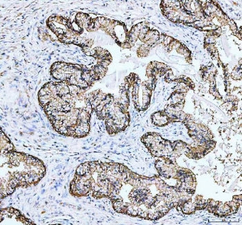 IHC staining of FFPE human prostate cancer tissue with Junctional adhesion molecule A antibody. HIER