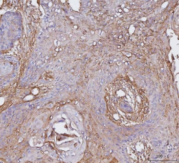 IHC staining of FFPE human esophageal squamous carcinoma tissue with CD51 antibody. HIER: boil tissu