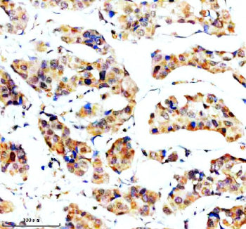 Immunohistochemical staining of SORL1 using anti-SORL1 antibody. SORL1 was detected in a paraffin-em