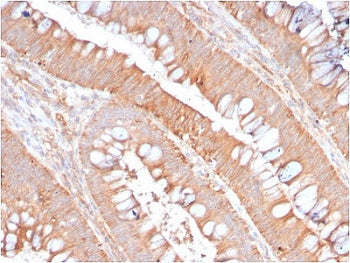 IHC staining of FFPE human colon carinoma with recombinant CD59 antibody (clone MACIF/2867R) . HIER: