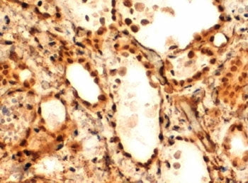 IHC testing of FFPE human thyroid gland with FOXE1 antibody at 2ug/ml. HIER: steamed with pH9 Tris/E