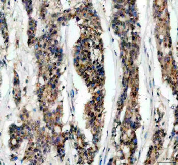 IHC staining of FFPE human breast cancer tissue with IkB beta antibody, HRP-secondary and DAB substr