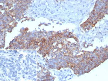 IHC staining of FFPE human ovarian carcinoma tissue with recombinant MSLN antibody (clone MSLN/8331R