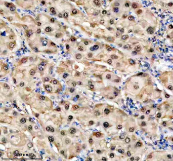 Immunohistochemical staining of TKFC using anti-TKFC antibody. TKFC was detected in a paraffin-embed