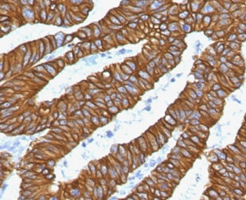 IHC staining of FFPE human colon carinoma with recombinant Keratin 18 antibody (clone CTKN18-2R). Re