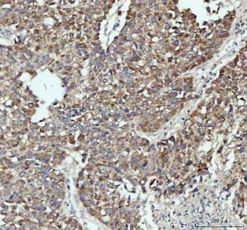 IHC staining of FFPE human liver cancer tissue with PAH antibody. HIER: boil tissue sections in pH8