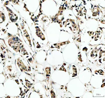 IHC staining of FFPE human breast cancer tissue with IRF9 antibody, HRP-secondary and DAB substrate.