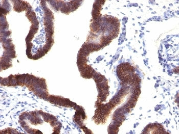 IHC: Formalin-fixed, paraffin-embedded human ovarian carcinoma stained with EpCAM antibody (EGP40/11