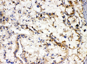 IHC staining of FFPE human liver cancer with APOL1 antibody. HIER: boil tissue sections in pH6, 10mM