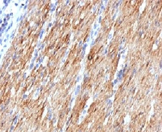 IHC: Formalin-fixed, paraffin-embedded human colon carcinoma stained with SMMHC antibody (MYH11/923)