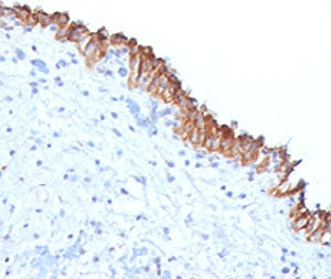 IHC testing of FFPE human bladder carcinoma with MAML2 antibody (clone MMLP2-1). Staining of FFPE ti