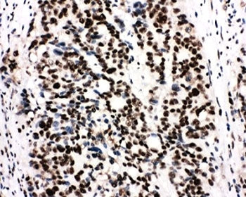 IHC-P: Ku80 antibody testing of human breast cancer tissue. HIER: boil tissue sections in pH6, 10mM