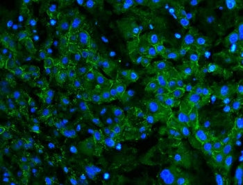 Immunofluorescent staining of FFPE human liver cancer with Cadherin 2 antibody. HIER: boil tissue se