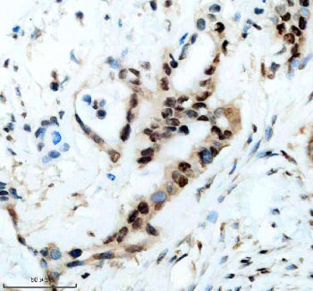 IHC staining of FFPE human pancreas cancer tissue with CIRBP antibody, HRP-secondary and DAB substra