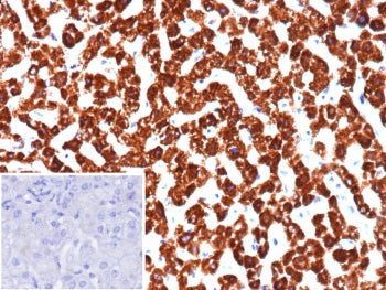 IHC staining of FFPE human hepatocellular carcinoma tissue with Phosphohistidine phosphatase 1 antib