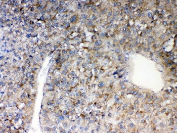 IHC testing of FFPE human liver cancer tissue with MAVS antibody at 1ug/ml. Required HIER: steam sec