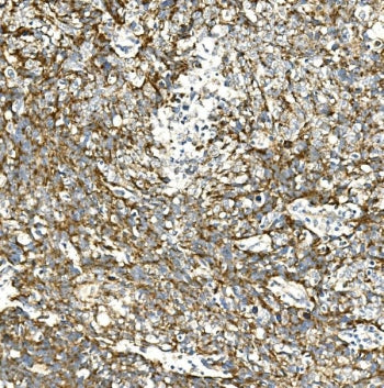 IHC staining of FFPE human lung cancer with VPS4A antibody. HIER: boil tissue sections in pH8 EDTA f
