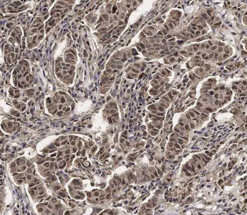IHC staining of FFPE human breast carcinoma tissue with SCXA antibody. HIER: steam section in pH6 ci
