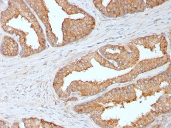 IHC testing of FFPE human prostate carcinoma with Ezrin antibody. Required HIER: boiling tissue sect