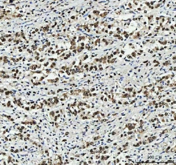 IHC staining of FFPE human hepatocellular carcinoma tissue with PC4 antibody. HIER: boil tissue sect