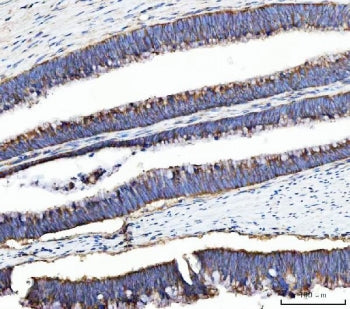 IHC staining of FFPE human colorectal adenocarcinoma tissue with UBA5 antibody. HIER: boil tissue se