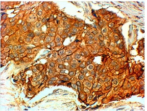 IHC staining of HER+ FFPE human breast cancer with HER2 antibody at 4ug/ml. HIER: Steamed with pH6 c